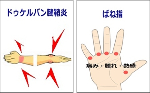 親指 の 付け根 が 痛い 腱鞘炎
